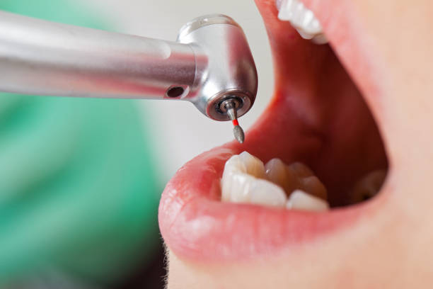 Best Urgent Dental Care for Toothache in San Rafael, CA